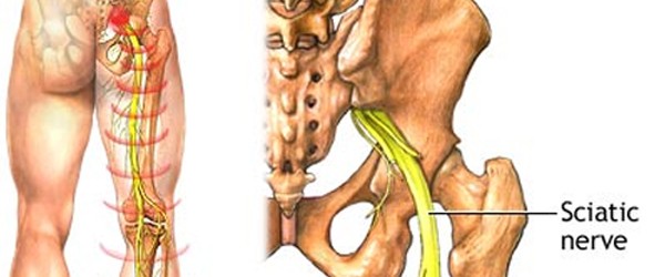 Q & A, Healing Sciatica